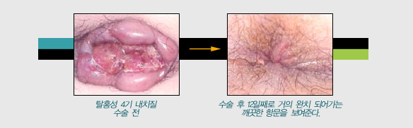 치질 수술전후사진